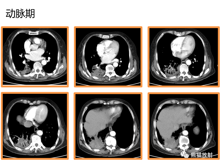 影像PPT - 【病例】肺黏液腺癌2例CT影像-5