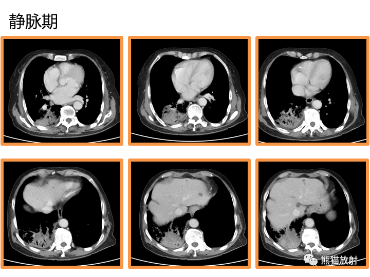 影像PPT - 【病例】肺黏液腺癌2例CT影像-6