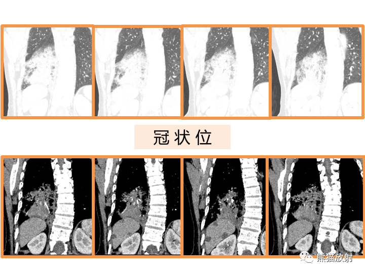 影像PPT - 【病例】肺黏液腺癌2例CT影像-7