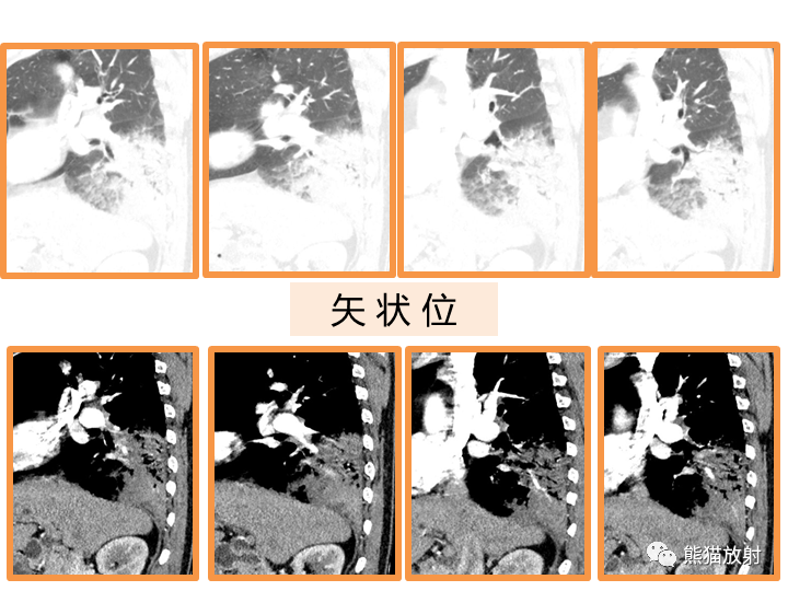 影像PPT - 【病例】肺黏液腺癌2例CT影像-8