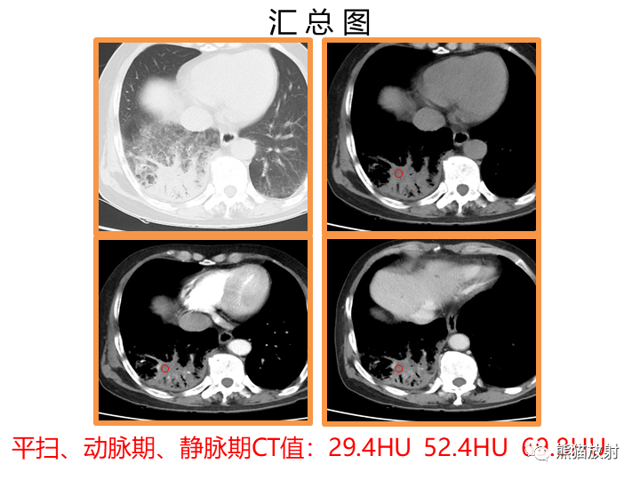影像PPT - 【病例】肺黏液腺癌2例CT影像-9