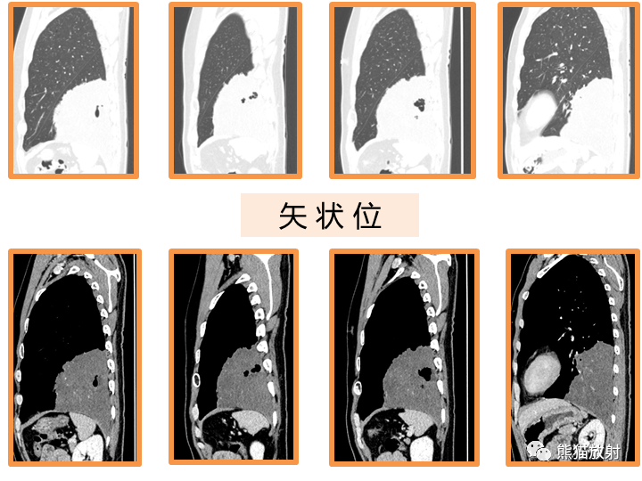 影像PPT - 【病例】肺黏液腺癌2例CT影像-18