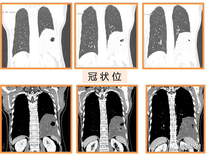 影像PPT - 【病例】肺黏液腺癌2例CT影像-17