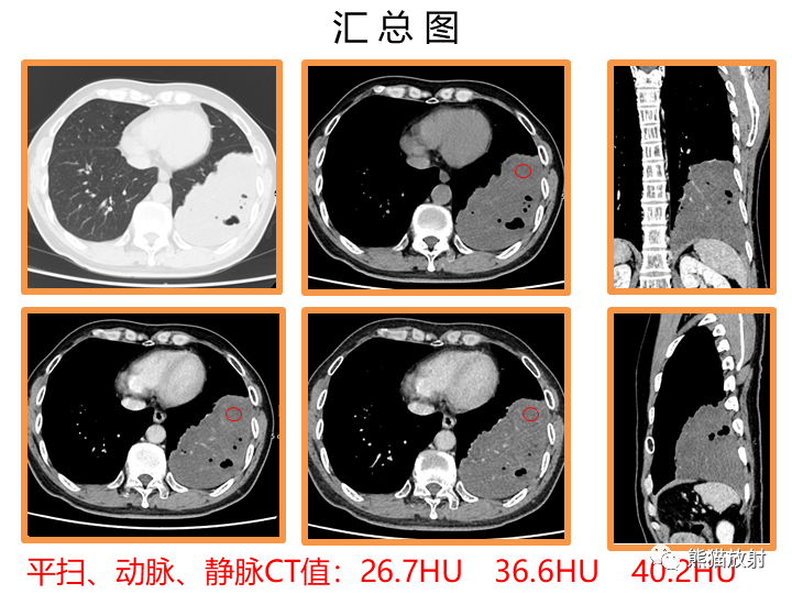 影像PPT - 【病例】肺黏液腺癌2例CT影像-19