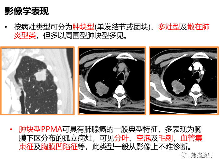 影像PPT - 【病例】肺黏液腺癌2例CT影像-25
