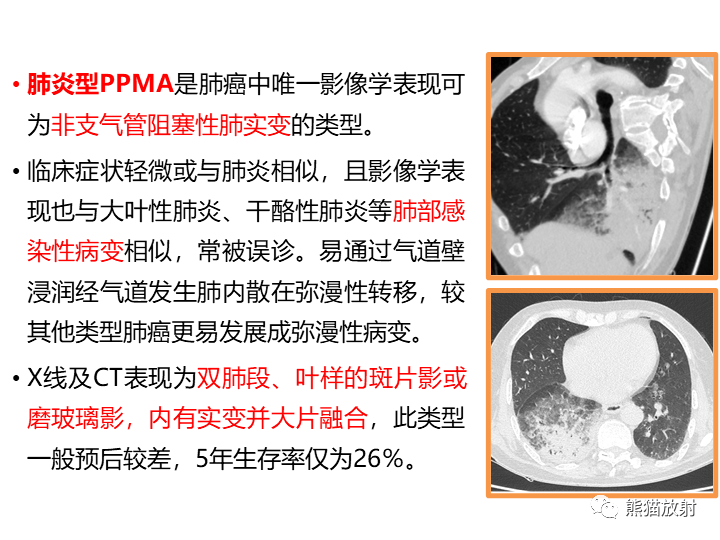 影像PPT - 【病例】肺黏液腺癌2例CT影像-26