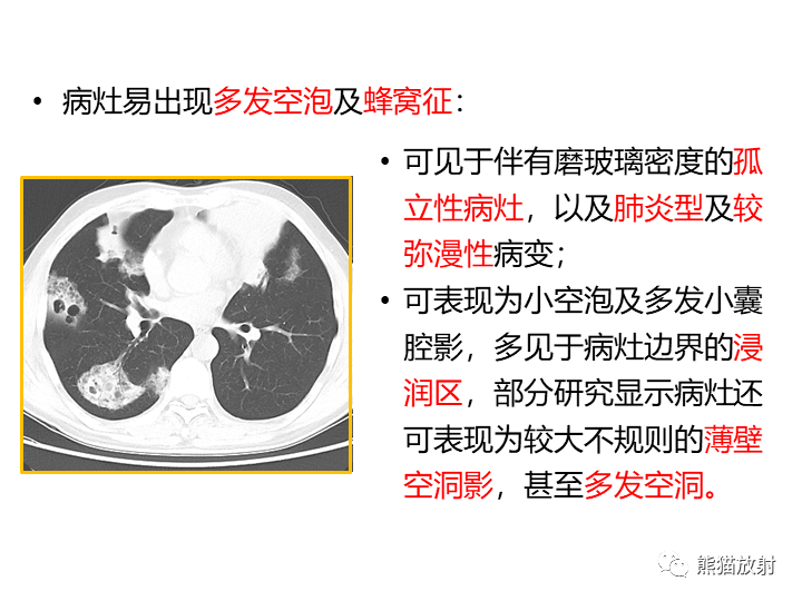 影像PPT - 【病例】肺黏液腺癌2例CT影像-28