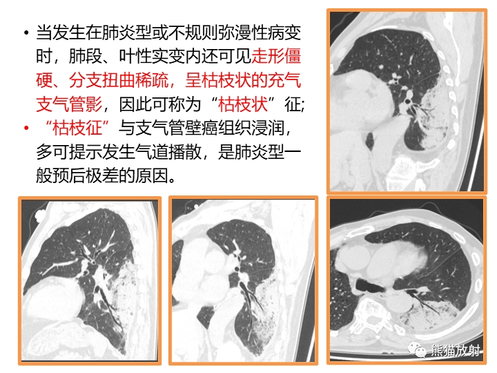 影像PPT - 【病例】肺黏液腺癌2例CT影像-29
