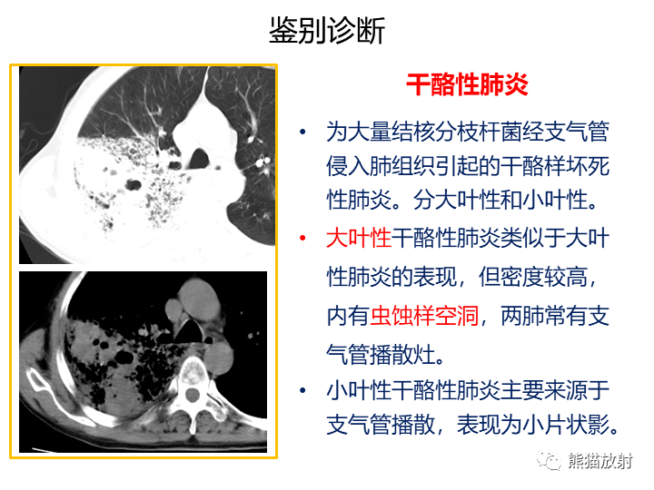 影像PPT - 【病例】肺黏液腺癌2例CT影像-33