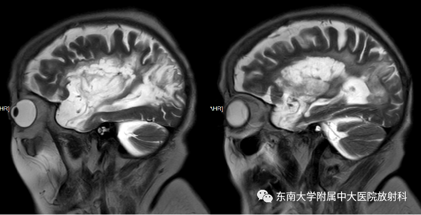 影像PPT - 【PPT】脑皮质层状坏死的影像-4