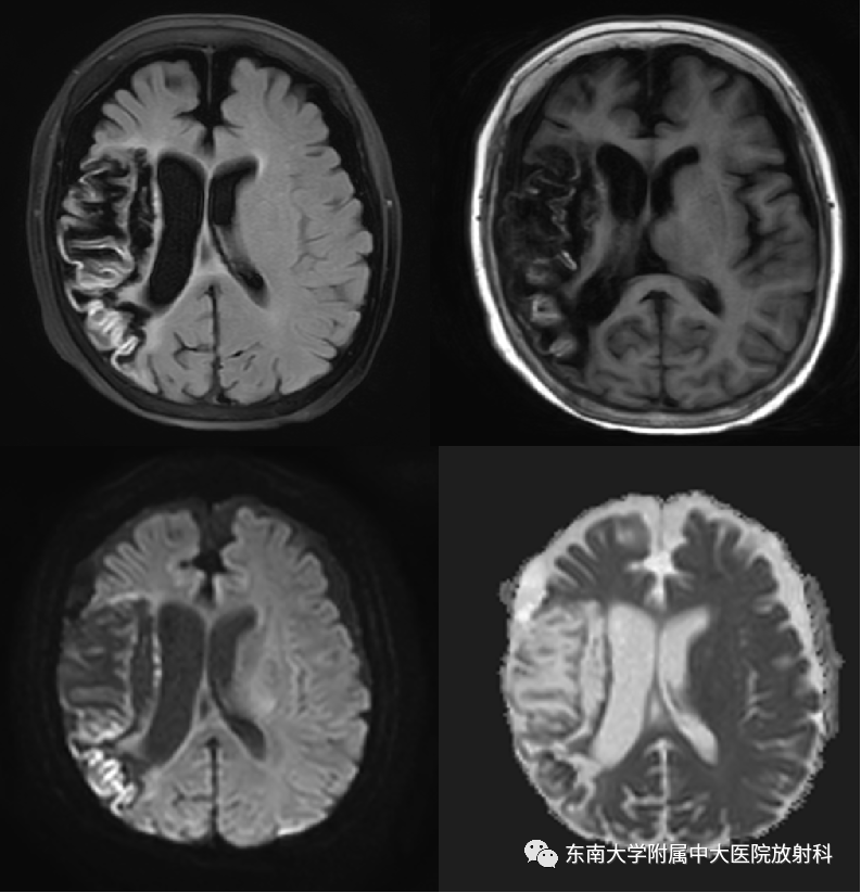 影像PPT - 【PPT】脑皮质层状坏死的影像-2