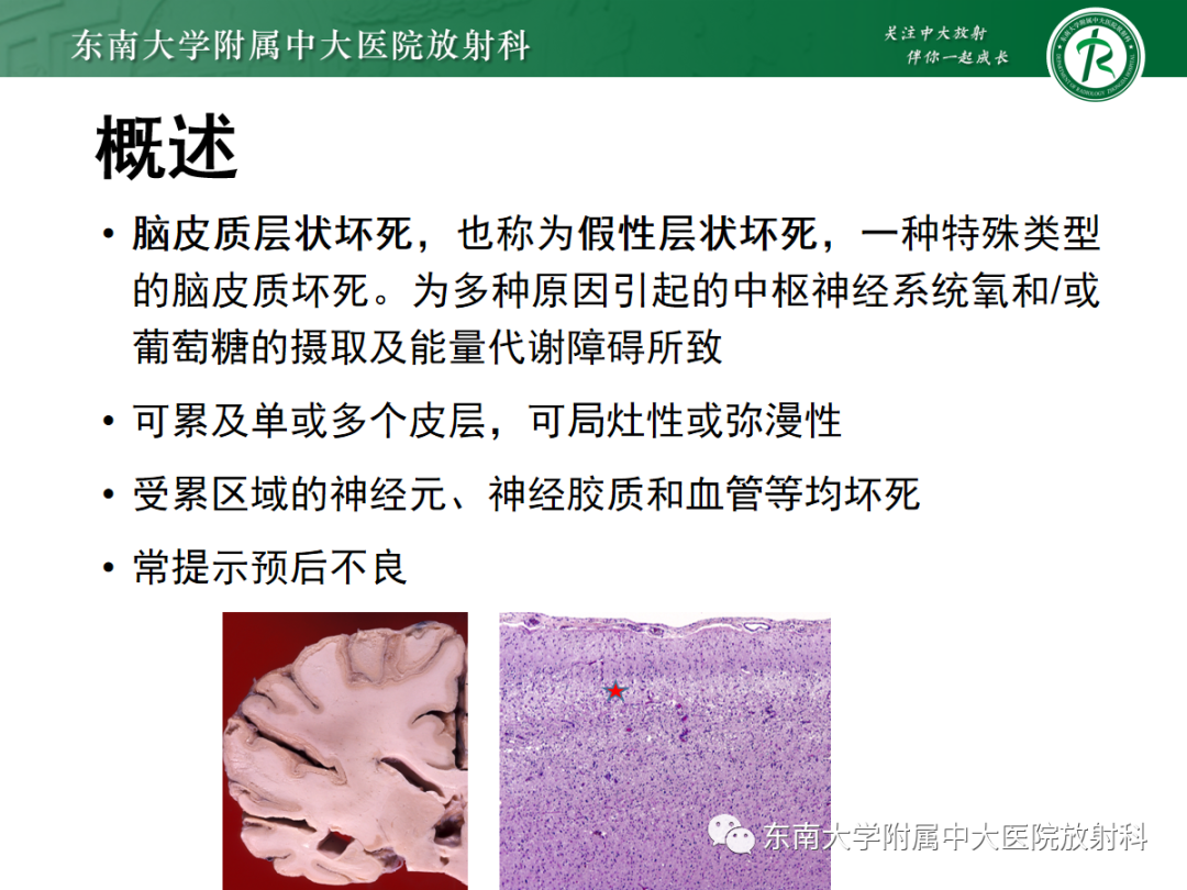影像PPT - 【PPT】脑皮质层状坏死的影像-6