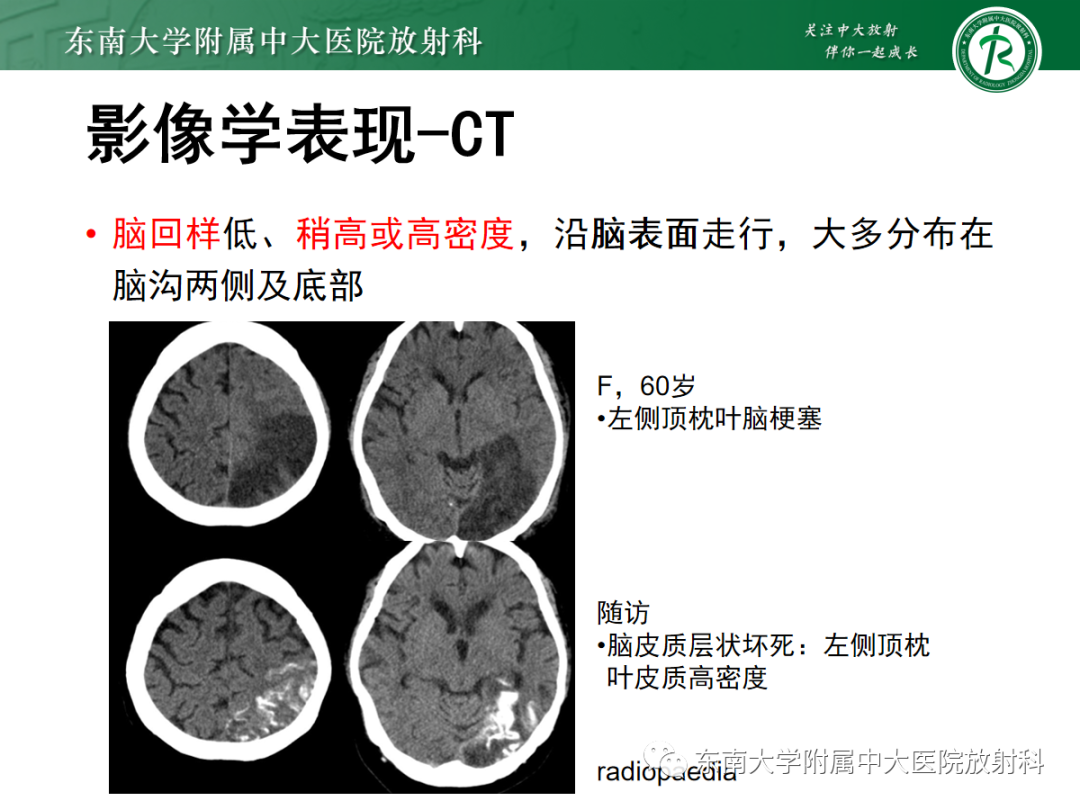 影像PPT - 【PPT】脑皮质层状坏死的影像-10