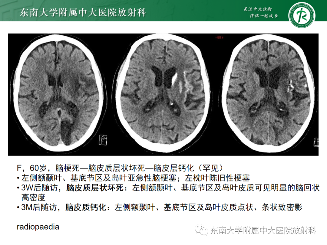 影像PPT - 【PPT】脑皮质层状坏死的影像-11