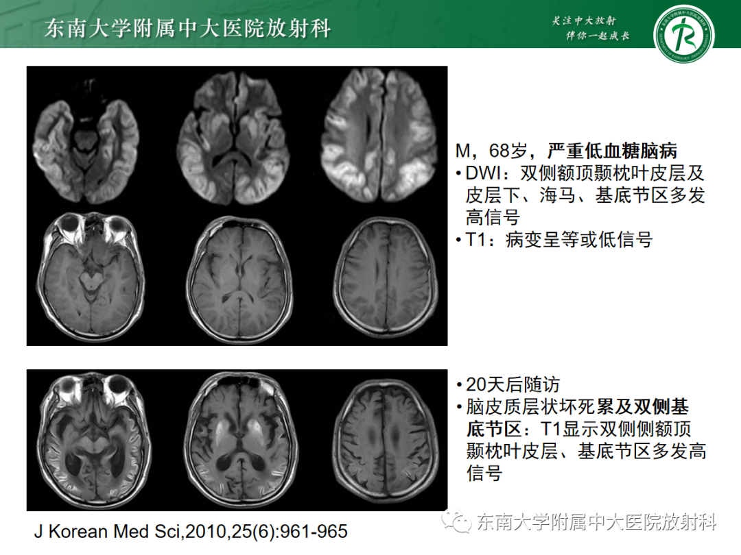 影像PPT - 【PPT】脑皮质层状坏死的影像-15
