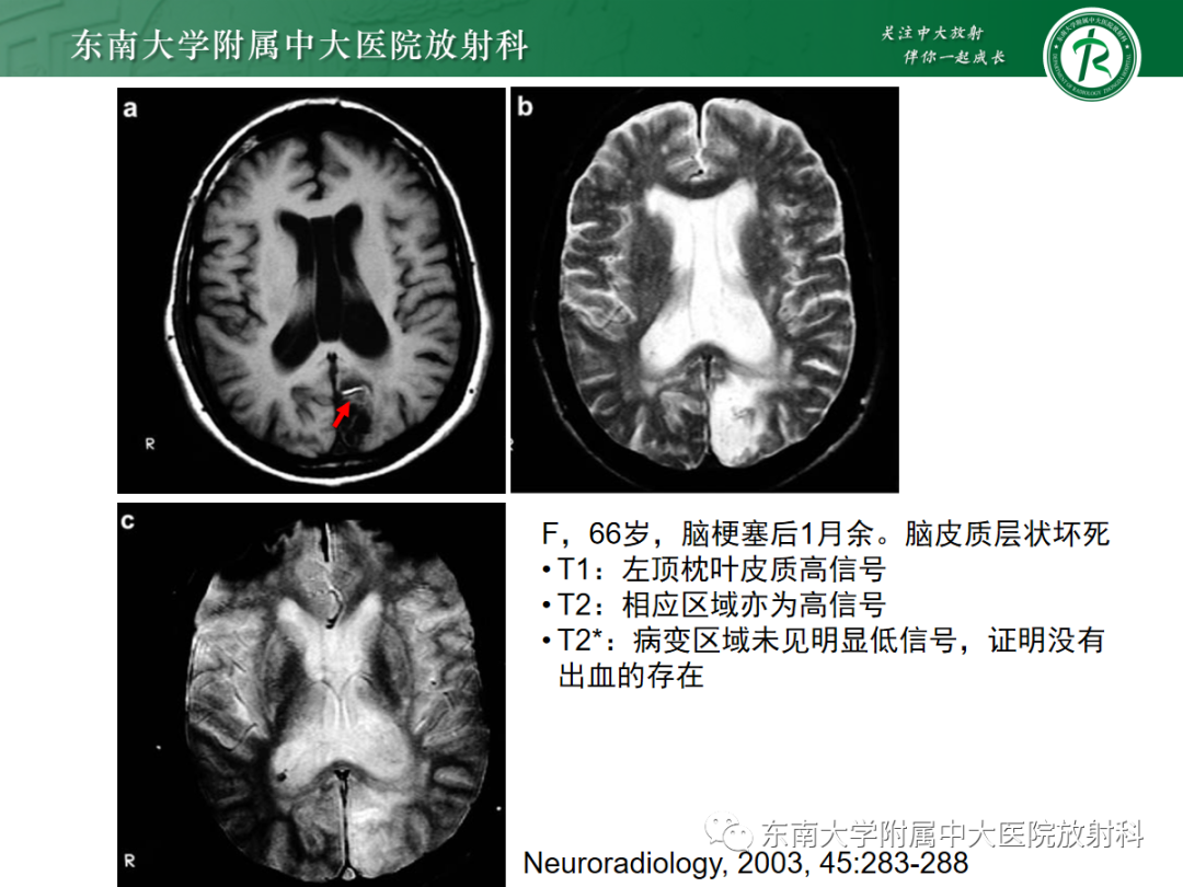 影像PPT - 【PPT】脑皮质层状坏死的影像-13