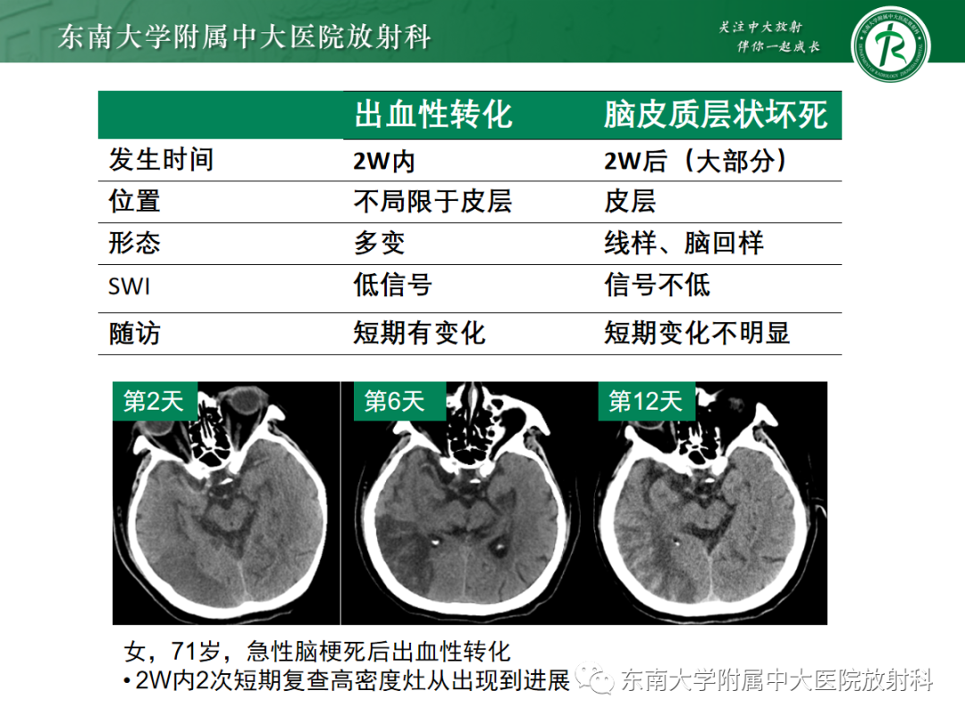 影像PPT - 【PPT】脑皮质层状坏死的影像-18