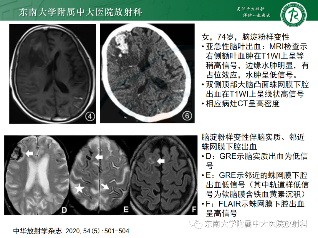 影像PPT - 【PPT】脑皮质层状坏死的影像-20