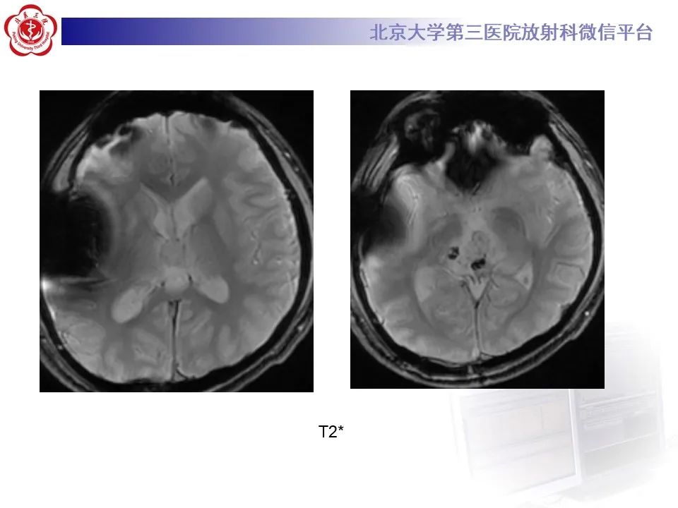 影像PPT - 【PPT】松果体区生殖细胞瘤-5