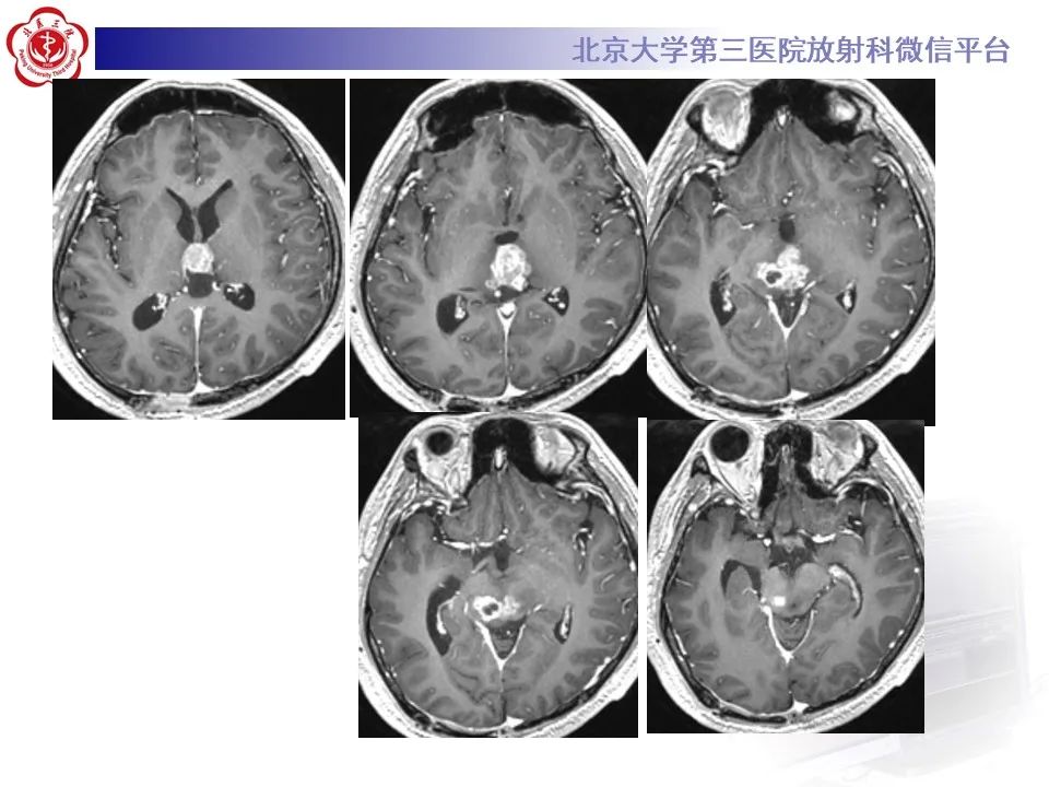 影像PPT - 【PPT】松果体区生殖细胞瘤-6