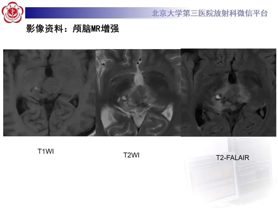影像PPT - 【PPT】松果体区生殖细胞瘤-4