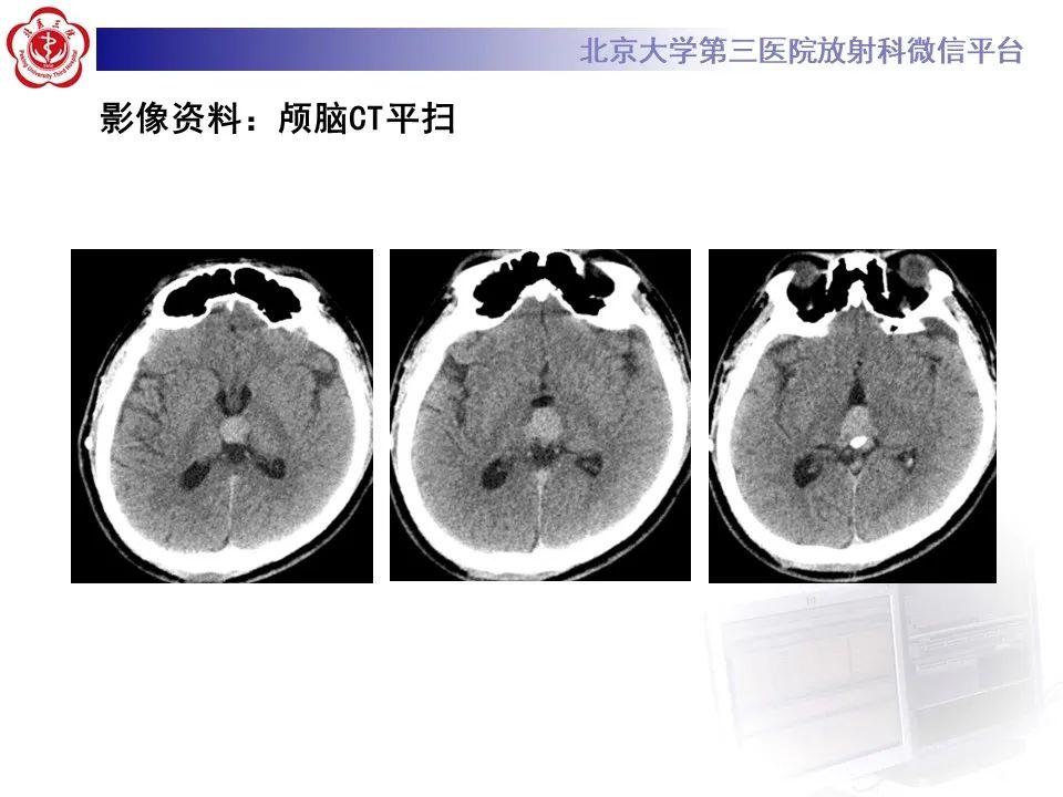 影像PPT - 【PPT】松果体区生殖细胞瘤-3