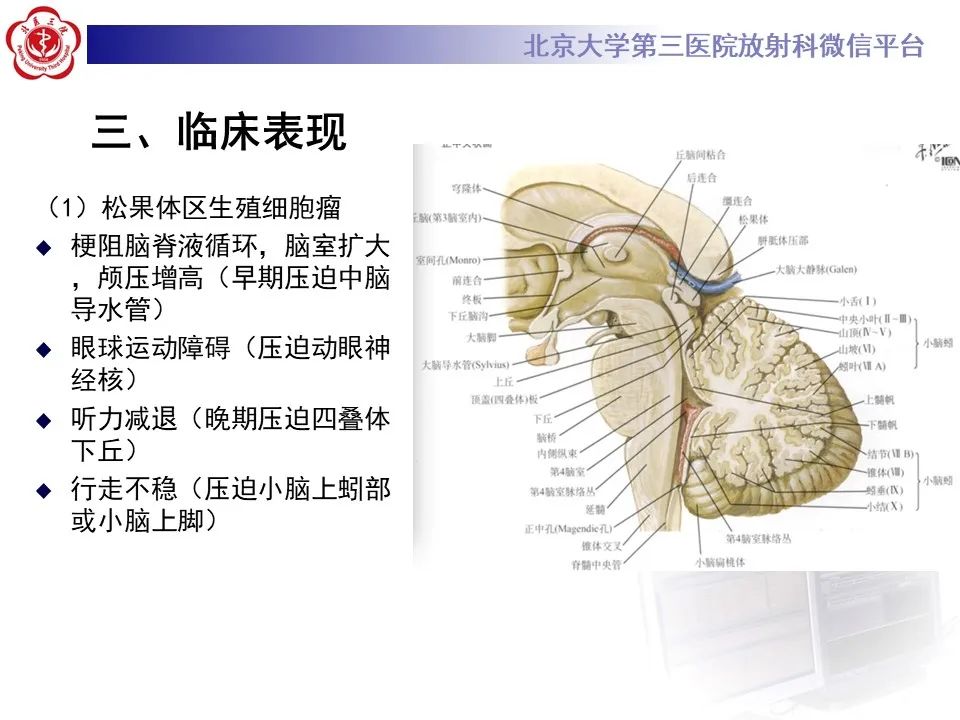 影像PPT - 【PPT】松果体区生殖细胞瘤-14