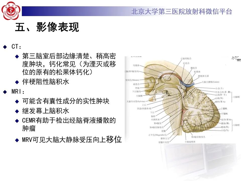 影像PPT - 【PPT】松果体区生殖细胞瘤-17