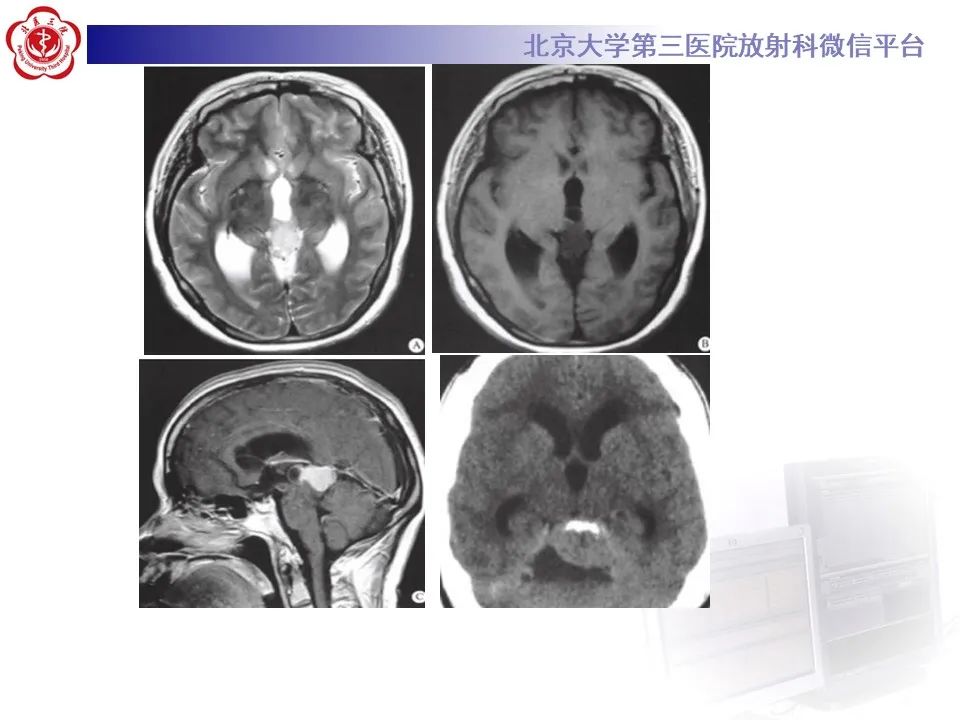 影像PPT - 【PPT】松果体区生殖细胞瘤-22