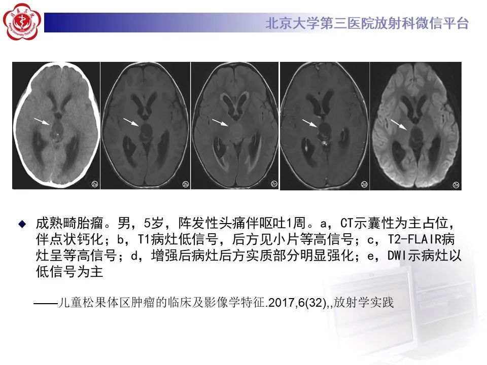 影像PPT - 【PPT】松果体区生殖细胞瘤-20