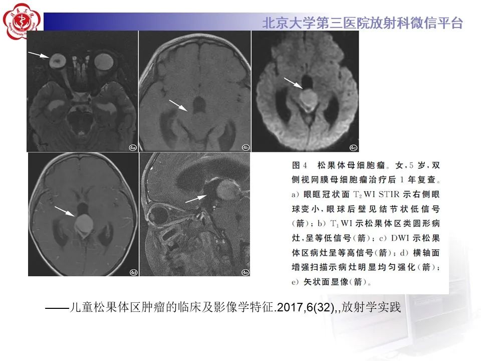 影像PPT - 【PPT】松果体区生殖细胞瘤-24
