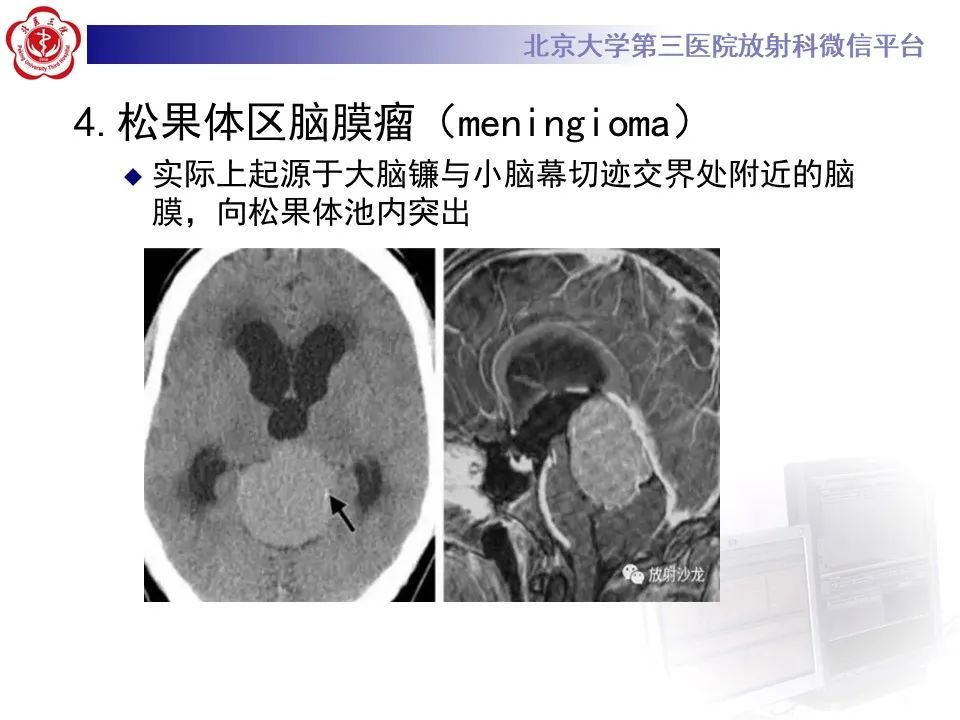 影像PPT - 【PPT】松果体区生殖细胞瘤-25