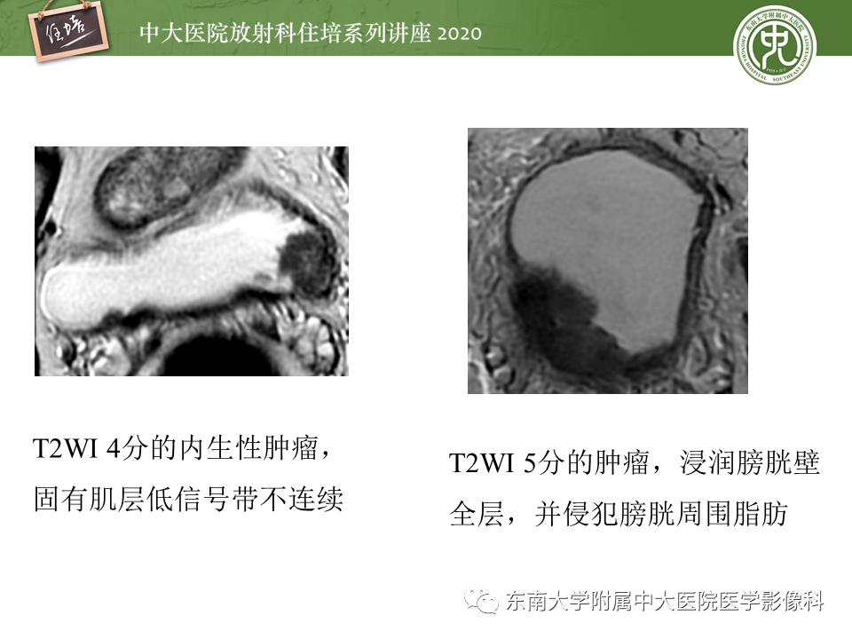 影像PPT - 【PPT】膀胱Ⅵ-RADS解读-16
