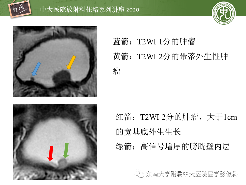影像PPT - 【PPT】膀胱Ⅵ-RADS解读-15