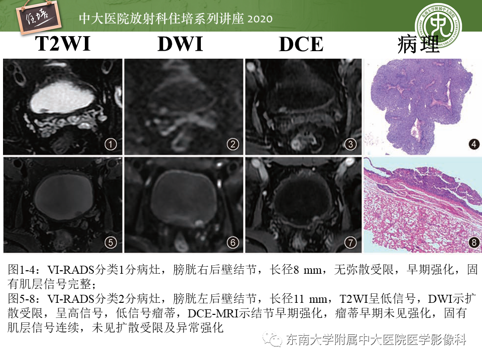 影像PPT - 【PPT】膀胱Ⅵ-RADS解读-22