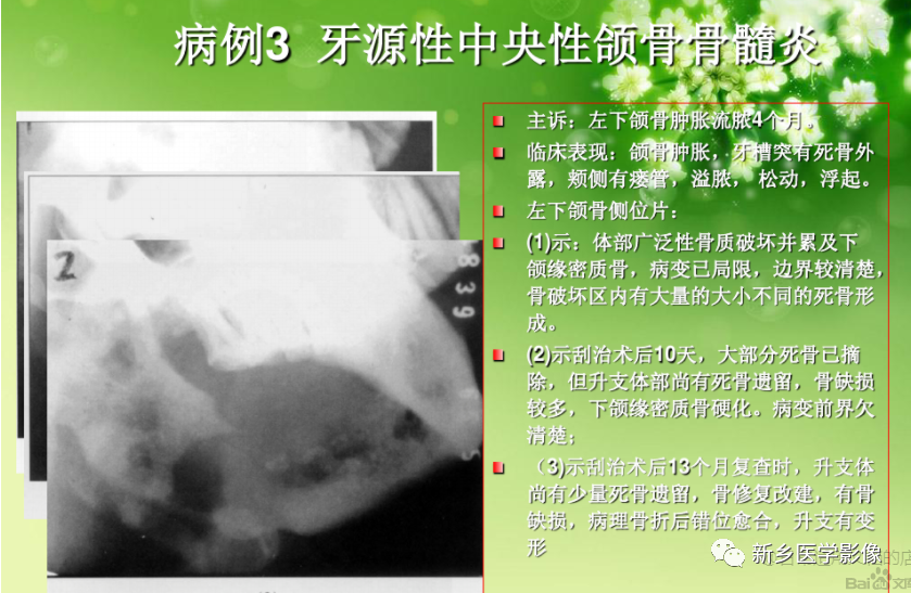 影像PPT - 【PPT】牙源性颌骨骨髓炎-6