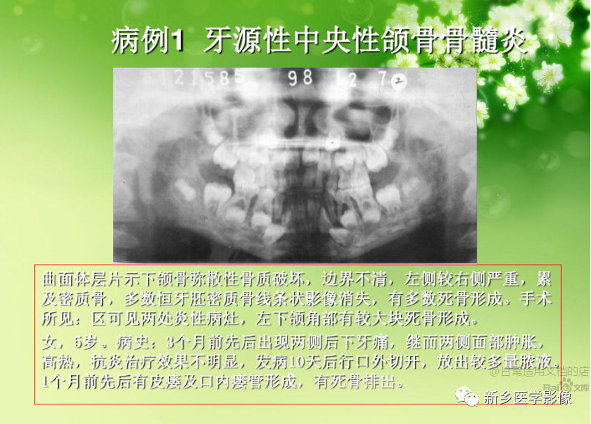 影像PPT - 【PPT】牙源性颌骨骨髓炎-4