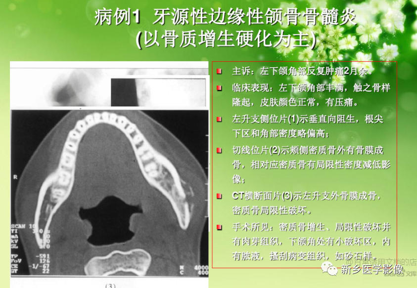 影像PPT - 【PPT】牙源性颌骨骨髓炎-11