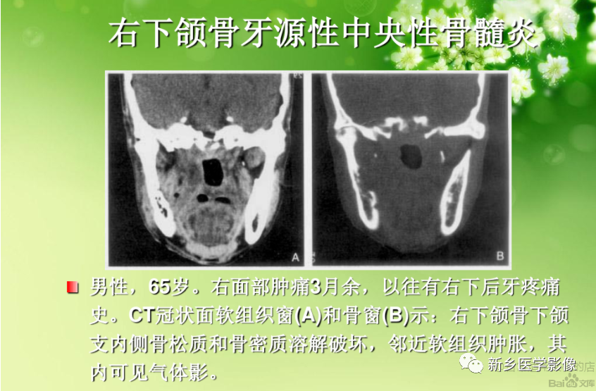 影像PPT - 【PPT】牙源性颌骨骨髓炎-7
