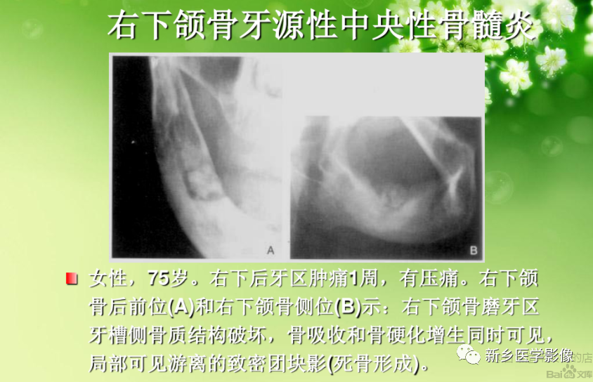 影像PPT - 【PPT】牙源性颌骨骨髓炎-9