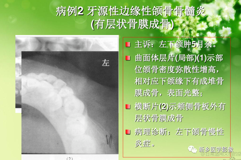 影像PPT - 【PPT】牙源性颌骨骨髓炎-12