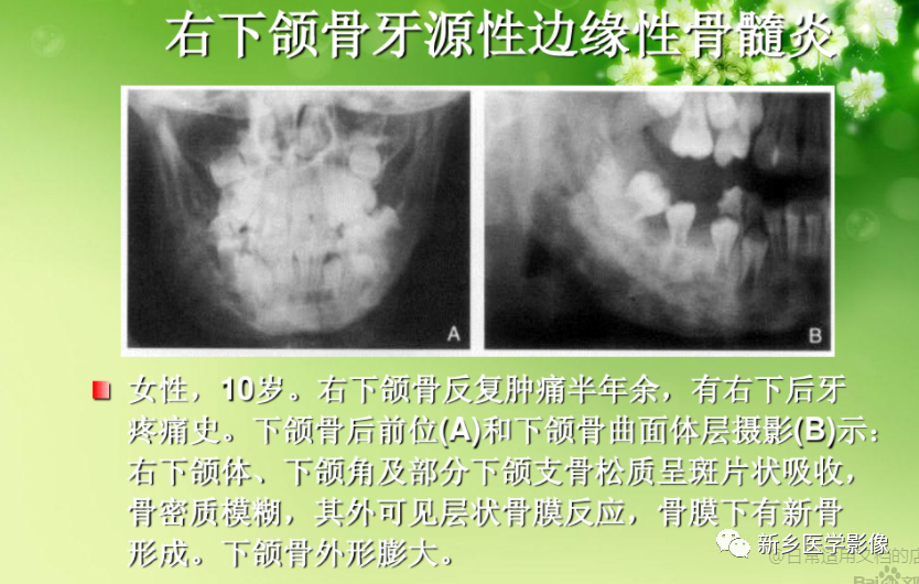 影像PPT - 【PPT】牙源性颌骨骨髓炎-14