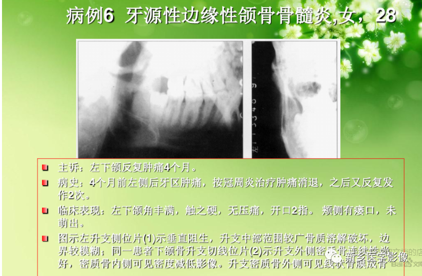 影像PPT - 【PPT】牙源性颌骨骨髓炎-13