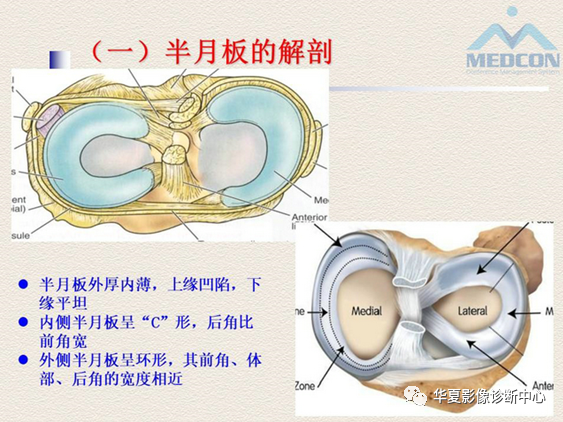 影像PPT - 【PPT】半月板常见病变及正常变异的MRI诊断-3