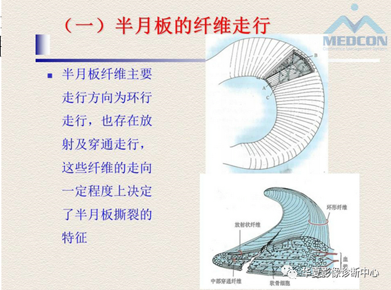 影像PPT - 【PPT】半月板常见病变及正常变异的MRI诊断-5