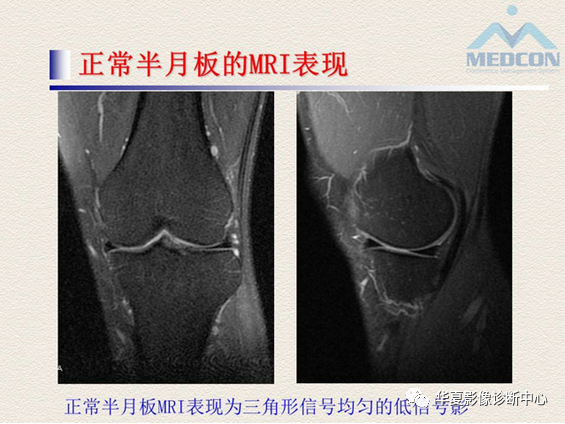 影像PPT - 【PPT】半月板常见病变及正常变异的MRI诊断-8