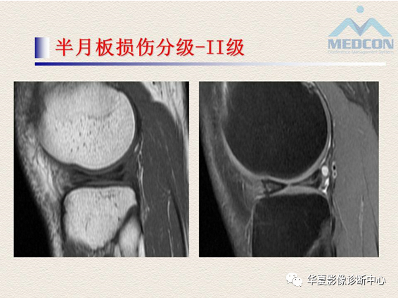 影像PPT - 【PPT】半月板常见病变及正常变异的MRI诊断-11