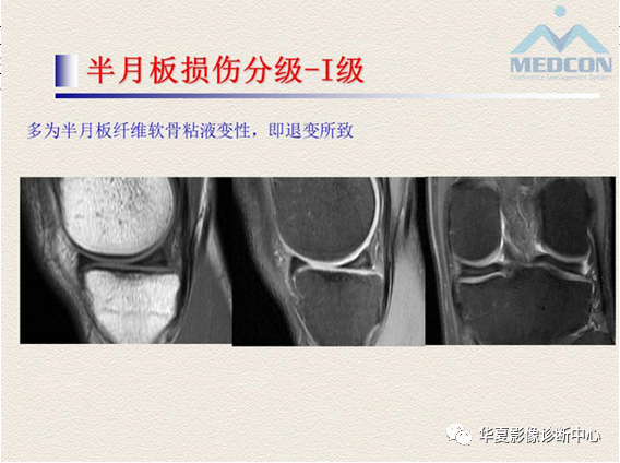 影像PPT - 【PPT】半月板常见病变及正常变异的MRI诊断-10