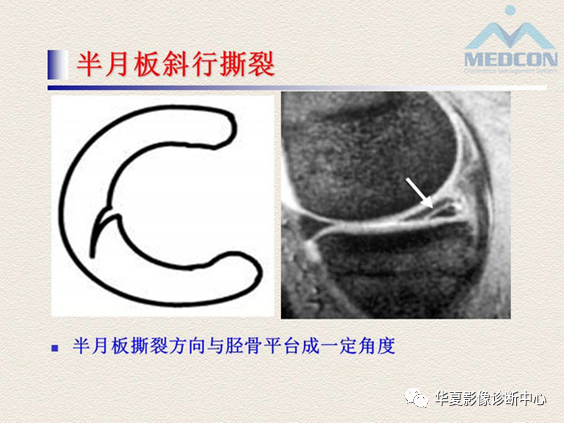 影像PPT - 【PPT】半月板常见病变及正常变异的MRI诊断-16