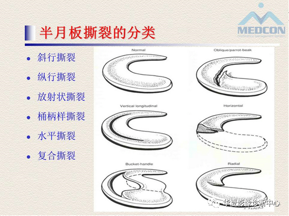 影像PPT - 【PPT】半月板常见病变及正常变异的MRI诊断-15